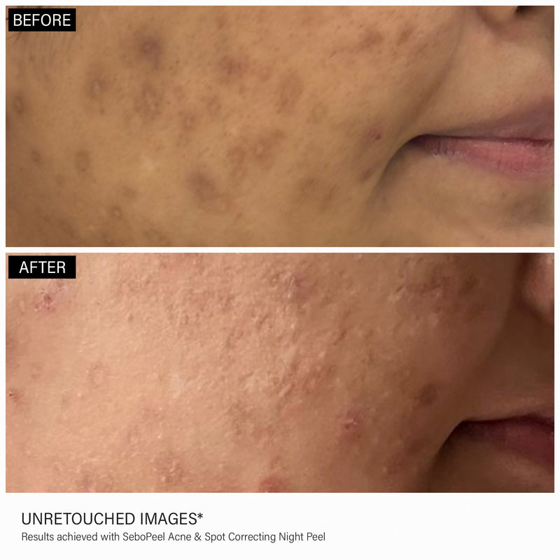 Perdura SeboPeel Acne & Spot Correcting Peel (20 ml)